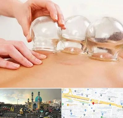 بادکش درمانی در رسالت