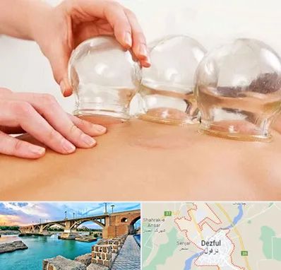 بادکش درمانی در دزفول