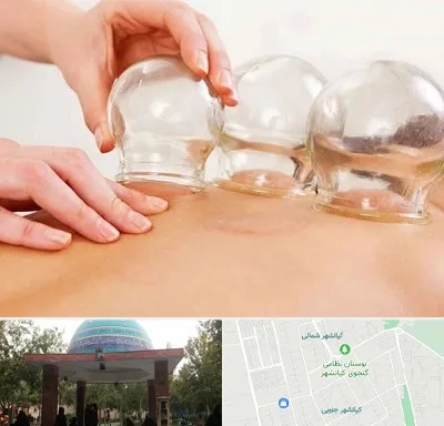 بادکش درمانی در کیانشهر