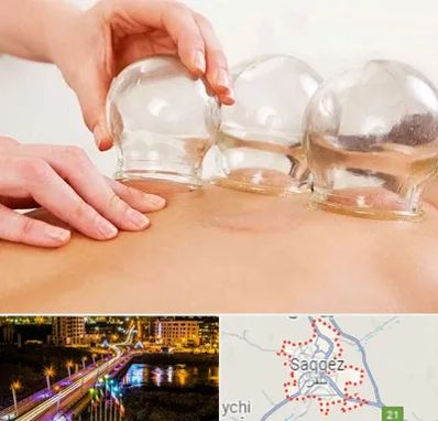 بادکش درمانی در سقز