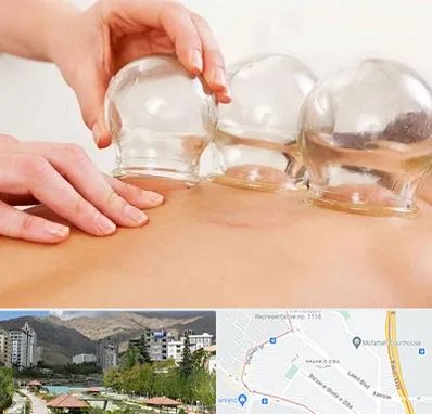 بادکش درمانی در شهر زیبا