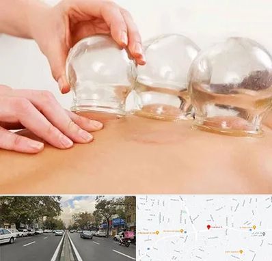 بادکش درمانی در دولت