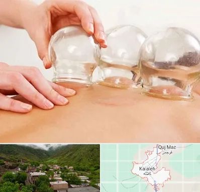 بادکش درمانی در کلاله
