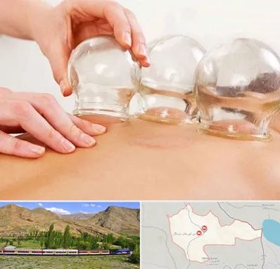 بادکش درمانی در خاش