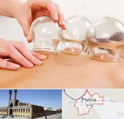 بادکش درمانی در پیشوا