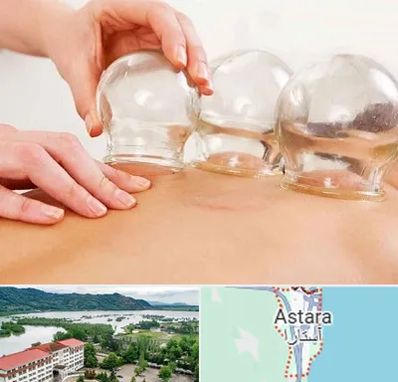 بادکش درمانی در آستارا