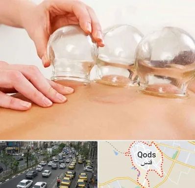 بادکش درمانی در شهر قدس