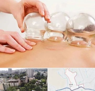 بادکش درمانی در اوین