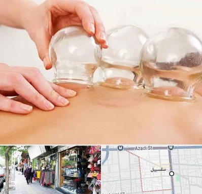 بادکش درمانی در سلسبیل