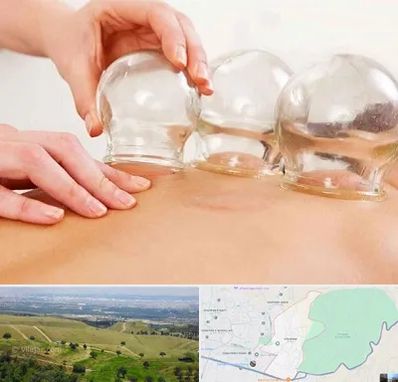 بادکش درمانی در سوهانک