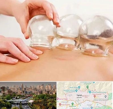 بادکش درمانی در منطقه 1 تهران