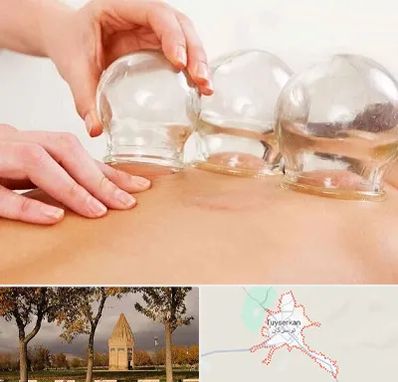 بادکش درمانی در تویسرکان
