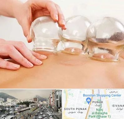 بادکش درمانی در پونک 