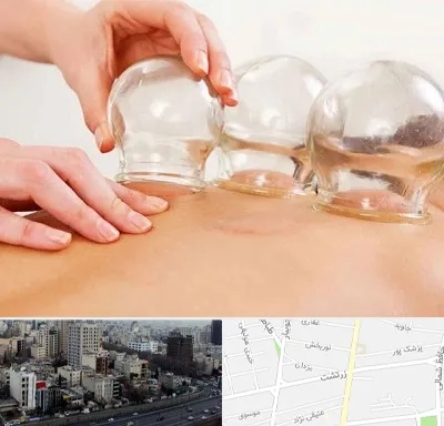 بادکش درمانی در زرتشت