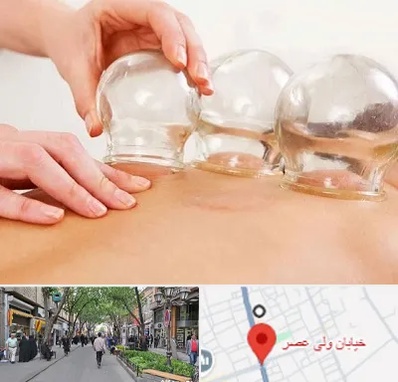 بادکش درمانی در ولیعصر شهریار