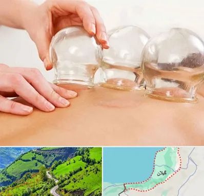 بادکش درمانی در گیلان