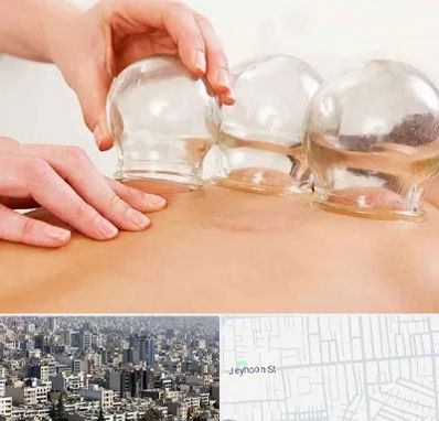 بادکش درمانی در جیحون
