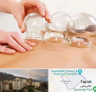 بادکش درمانی در زعفرانیه 