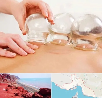 بادکش درمانی در هرمزگان
