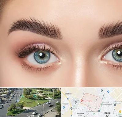 لیفت ابرو در شاهین ویلا کرج