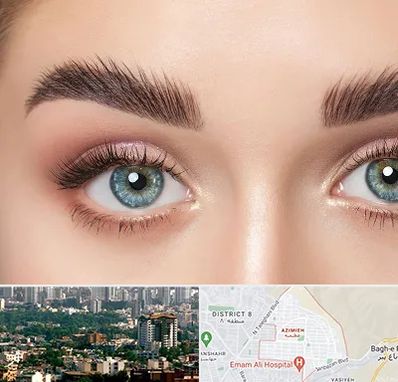 لیفت ابرو در عظیمیه کرج 