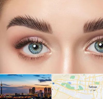 لیفت ابرو در غرب تهران 