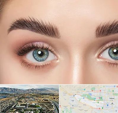 لیفت ابرو در منطقه 21 تهران