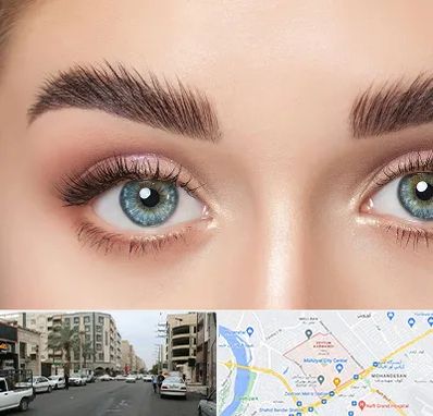 لیفت ابرو در زیتون کارمندی اهواز