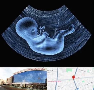 دکتر متخصص غربال گری در نصف راه تبریز