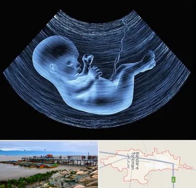 دکتر متخصص غربال گری در بندر ترکمن