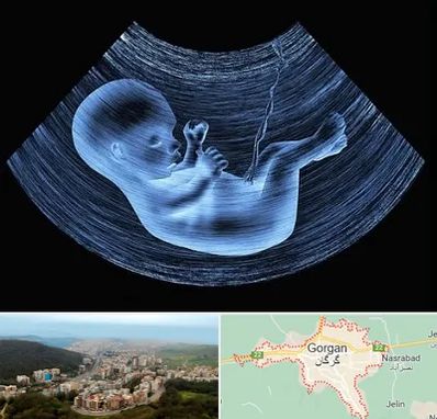 دکتر متخصص غربال گری در گرگان