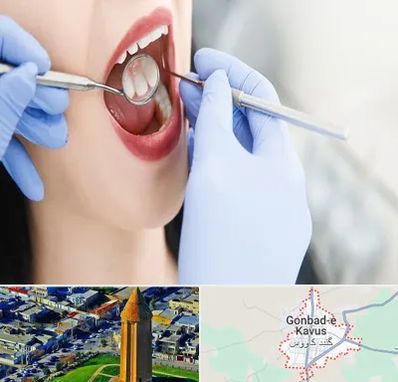 جراح دندان عقل در گنبد کاووس