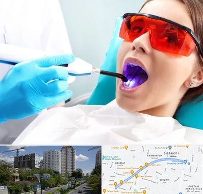 جراحی لثه با لیزر در اندرزگو