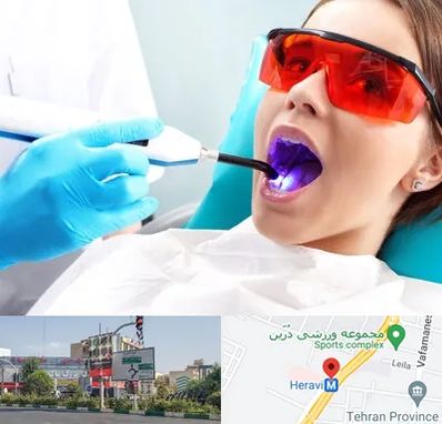 جراحی لثه با لیزر در هروی 