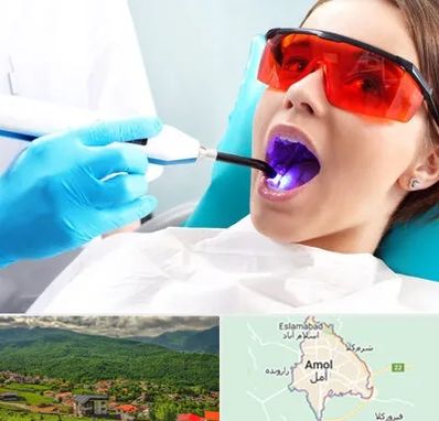 جراحی لثه با لیزر در آمل