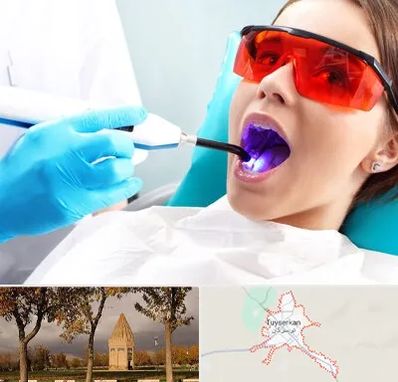جراحی لثه با لیزر در تویسرکان