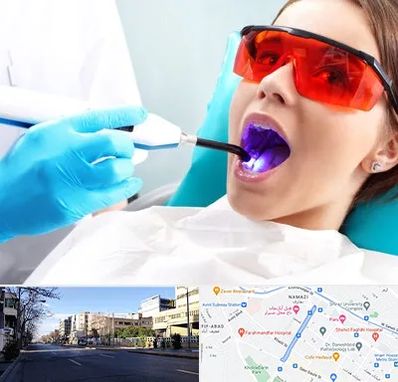 جراحی لثه با لیزر در خیابان ملاصدرا شیراز