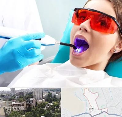 جراحی لثه با لیزر در اوین