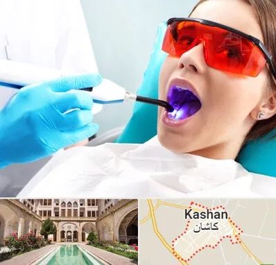 جراحی لثه با لیزر در کاشان