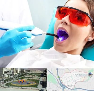 جراحی لثه با لیزر در مرزداران تبریز