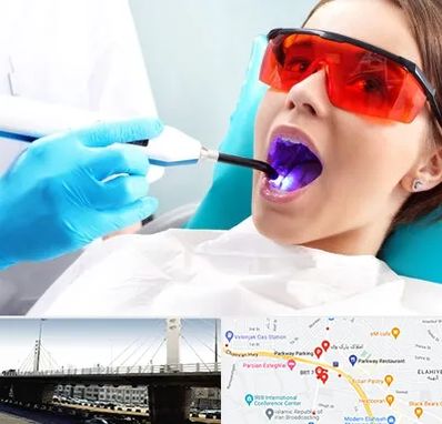 جراحی لثه با لیزر در پارک وی 