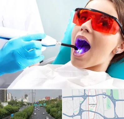 جراحی لثه با لیزر در توانیر