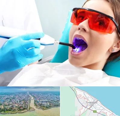 جراحی لثه با لیزر در تنکابن