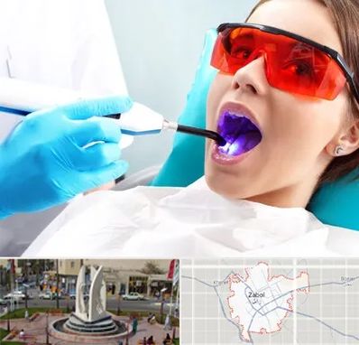 جراحی لثه با لیزر در زابل