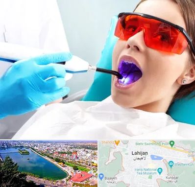 جراحی لثه با لیزر در لاهیجان