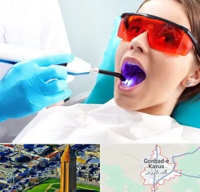 جراحی لثه با لیزر در گنبد کاووس
