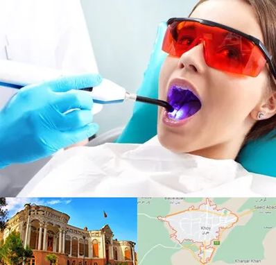 جراحی لثه با لیزر در خوی