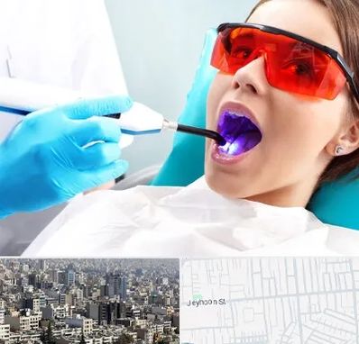 جراحی لثه با لیزر در جیحون