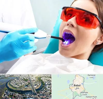 جراحی لثه با لیزر در بابل
