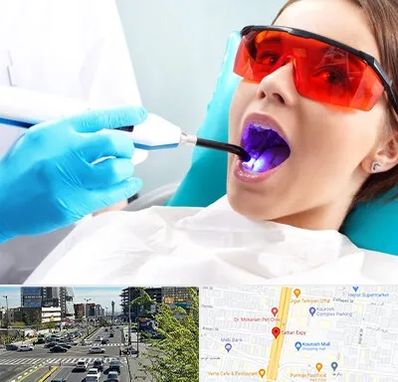 جراحی لثه با لیزر در ستاری